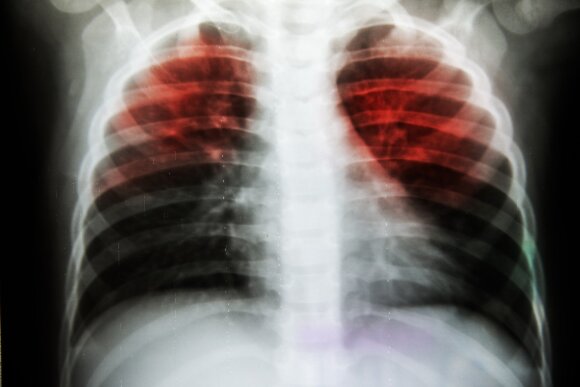 Tuberkuliozės pažeisti plaučiai