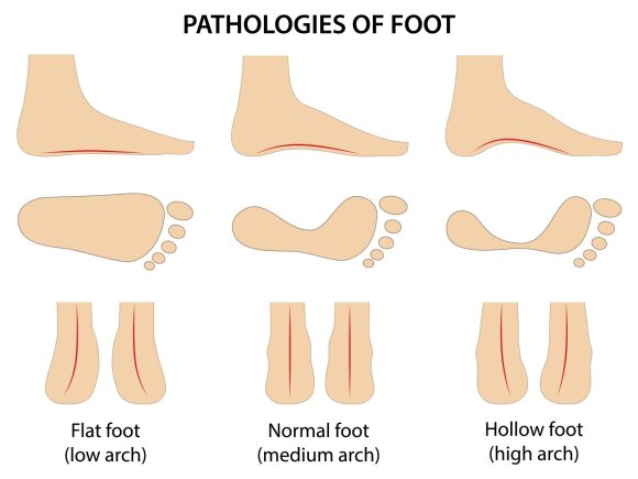 Pėdos skliautų išlinkimo tipai: normalus išlinkimas (normal); aukštas išlinkimas (high) ir plokščiapėdystė (flatfoot).